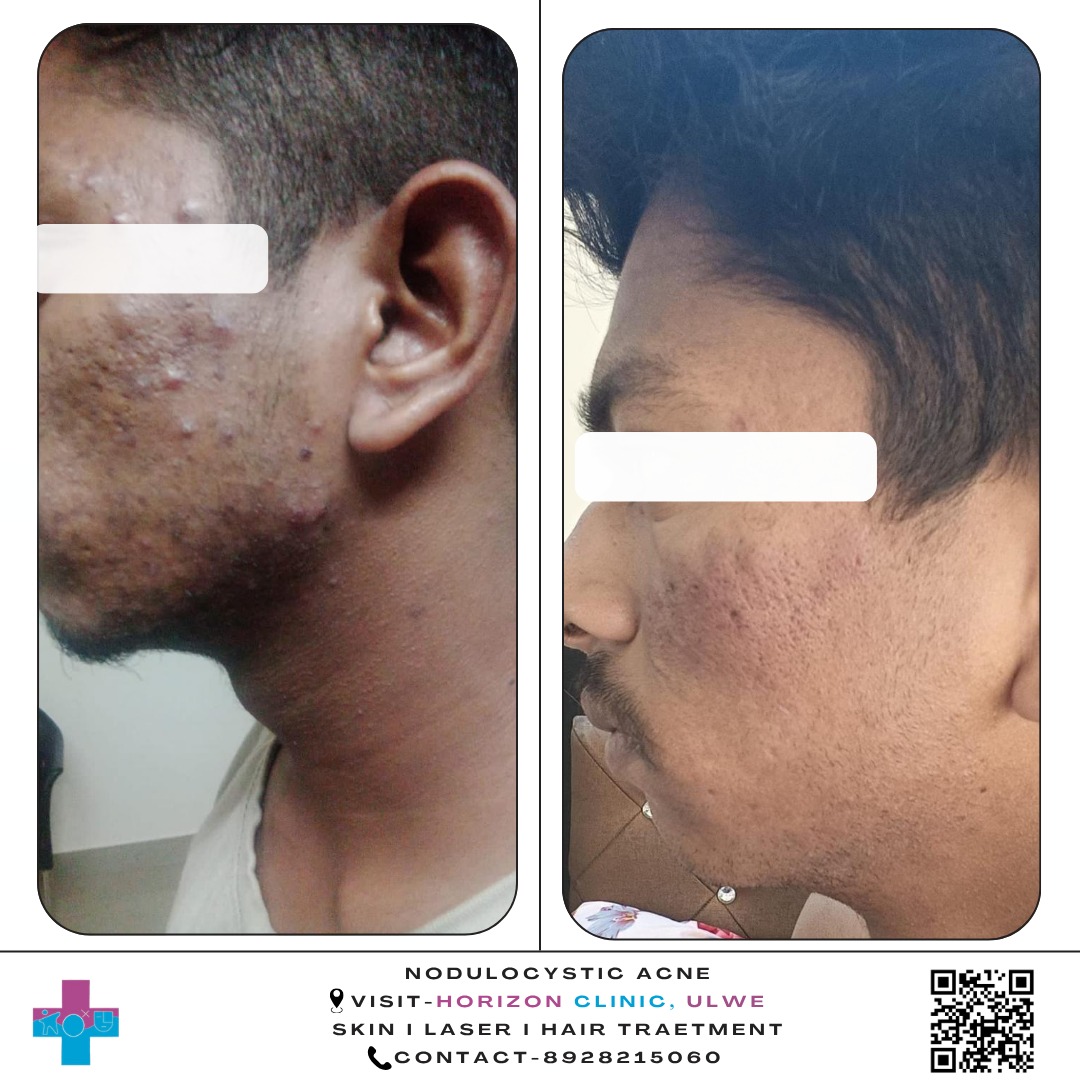 Nodulocystic Acne Clearance
